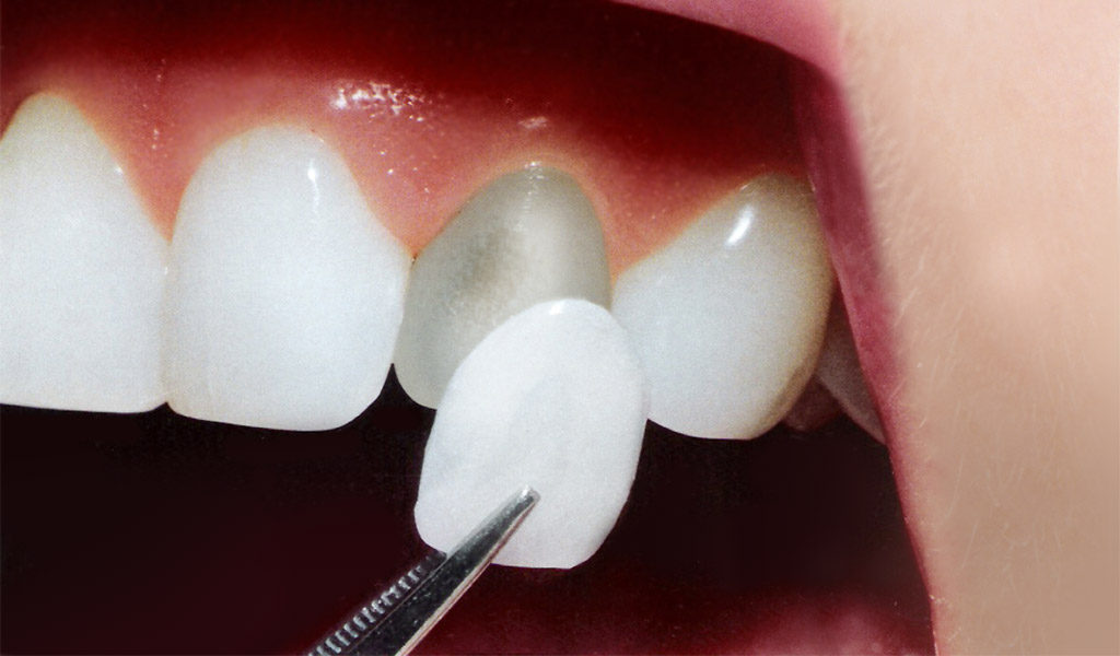 estética dental en Berga
