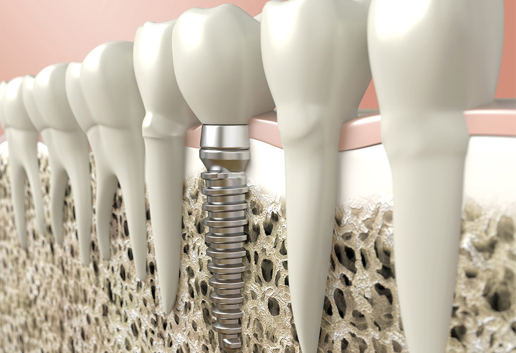 Implantología dental en Berga